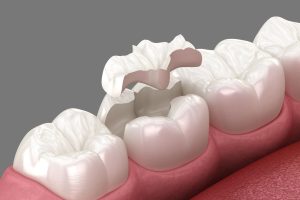 Dental Liners and Bases