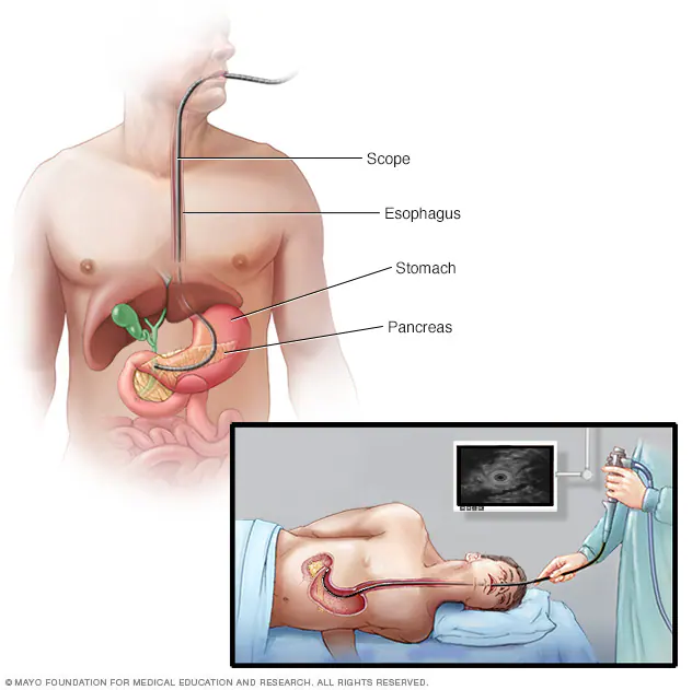 Pancreatic Cancer Diagnostic Market